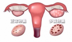 多囊卵巢综合症可以做试管婴儿吗